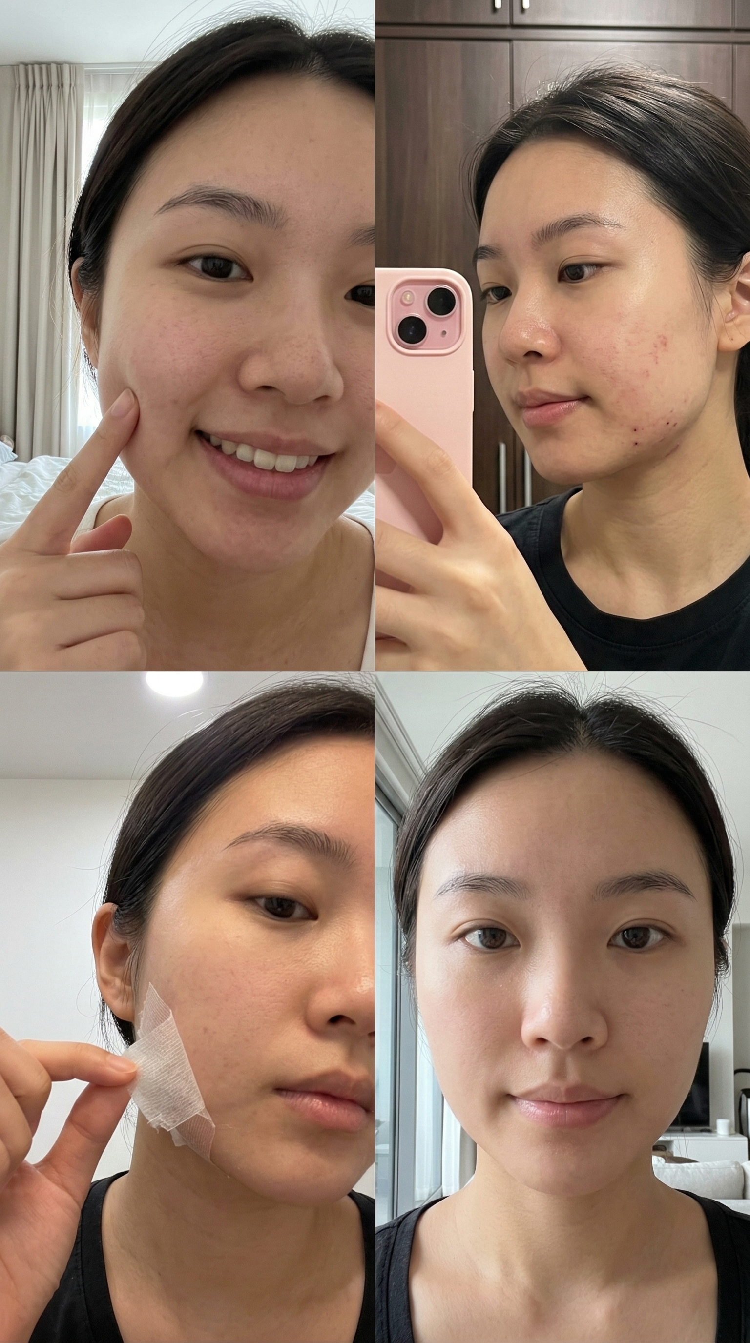 从“发面馒头脸”到紧致小V脸✨面部打薄真实恢复日记